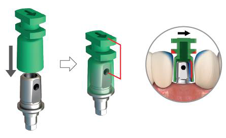 Illustration of a green impression cap lowered onto the abutment, then shown in place with a red line marking the alignment of the arrow with the perforated surface, and a close-up in the mouth with an arrow.