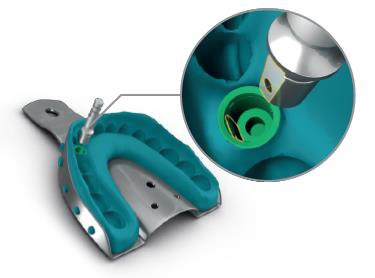Illustration of a metal impression tray filled with teal impression material, with a round close-up showing a screwdriver-type instrument at a green impression cap inside the material.