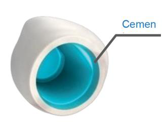 Illustration of a single tooth prosthesis shown from below with its inner wall coloured and labelled "Cemen".
