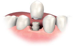 A temporary bridge shell placed over a temporary abutment in the gap between natural teeth, shown on a model of the gum.