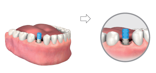 Two views of a lower jaw model: a temporary abutment with a blue top on the implant before marking, then a close-up circle with the abutment beside the neighbouring teeth, showing the occlusal level for marking.