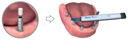 A white cotton-like plug in the screw hole of a temporary titanium abutment (close-up circle), then a paint tool marking the abutments on a lower jaw model; the pen is labelled “Paint Tool”.