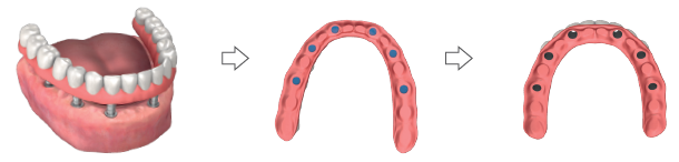 Three views: a lower acrylic prosthesis placed over the abutments on the jaw, the prosthesis with blue painted marks, and the prosthesis with holes drilled at the marked areas.