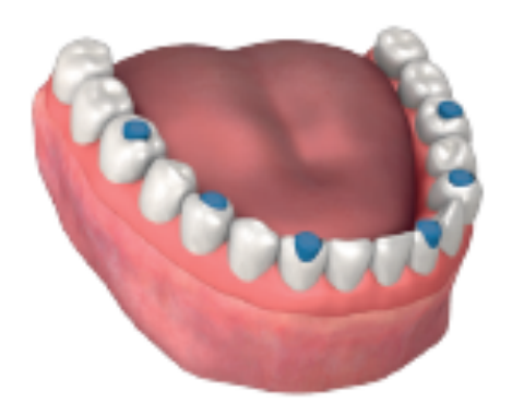 Lower jaw model with the acrylic prosthesis in place and the parts of the abutments remaining on the teeth painted blue.