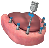A hex driver removing the connecting screw from a temporary titanium abutment on a lower jaw model with painted abutments.