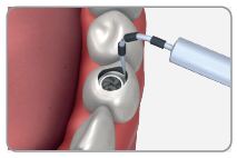 Liquid acrylic being applied with a syringe-type applicator into the space between a temporary abutment and the holed tooth.