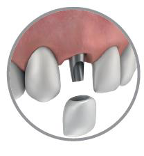 Gum with two front teeth and a grey abutment in the gap between them, with a crown held just below the abutment ready to be placed