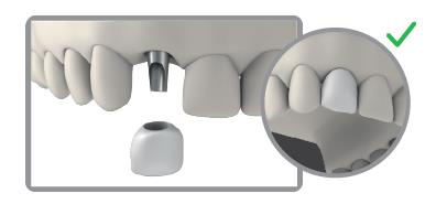 Front teeth with a grey abutment in the gap and a crown held above it; a magnified inset shows the crown seated over the abutment, with a green tick