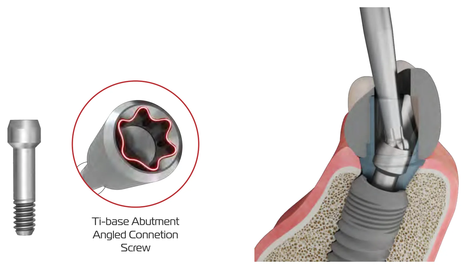 The Ti-base abutment angled connection screw and the angled hex driver reaching it through the abutment