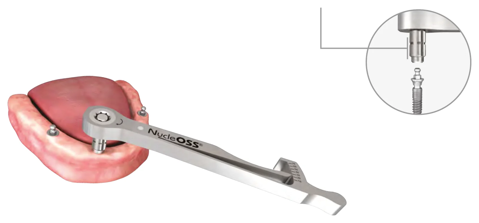 Fixing a ball abutment to the implant with the ball abutment tightening part and the NucleOSS ratchet