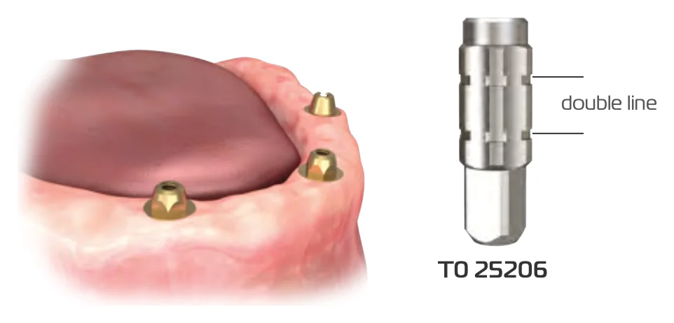 Multi unit abutment tightening part T0 25206, marked with a double line, and multi-unit abutments in a lower jaw