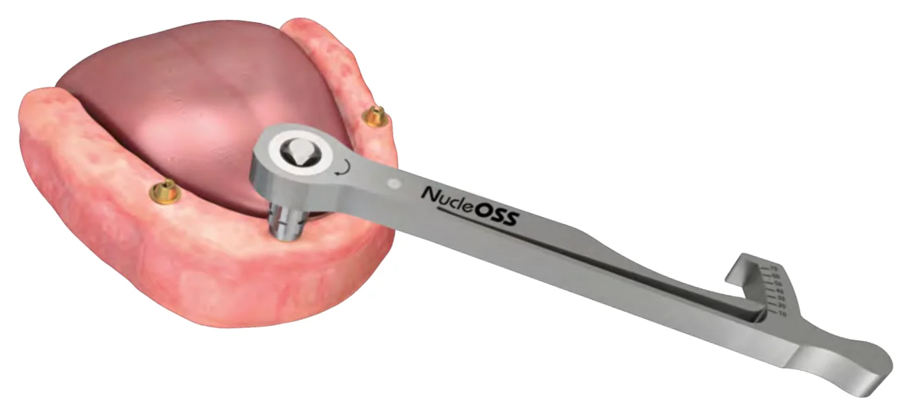 A multi unit angled abutment fixed to the implant with its connection screw and a NucleOSS torque ratchet