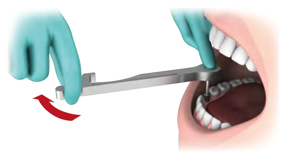 Using the ratchet for removal, with the direction arrow facing down