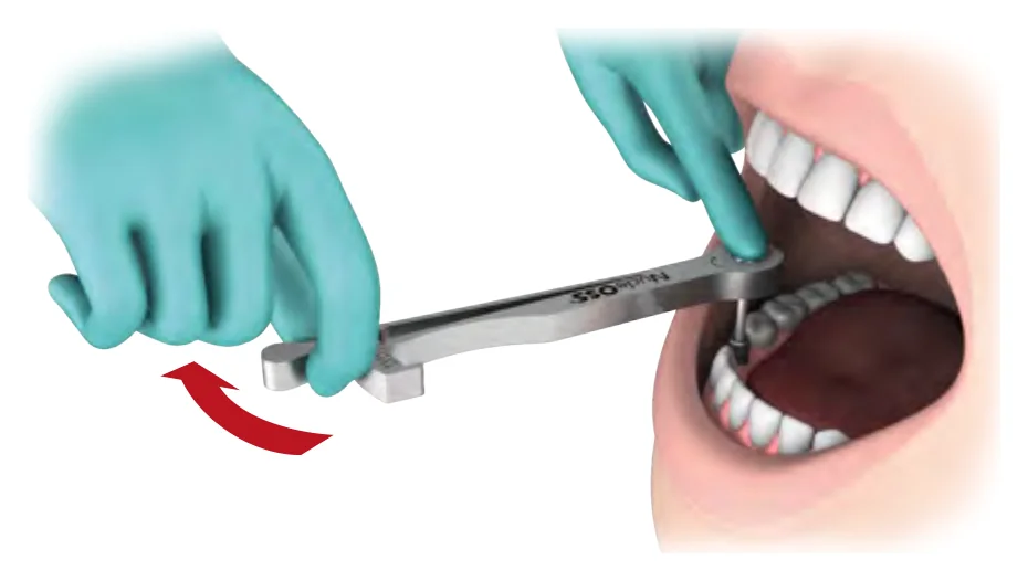 Using the ratchet as a torque ratchet, pulling the torque arm in the direction of the arrow