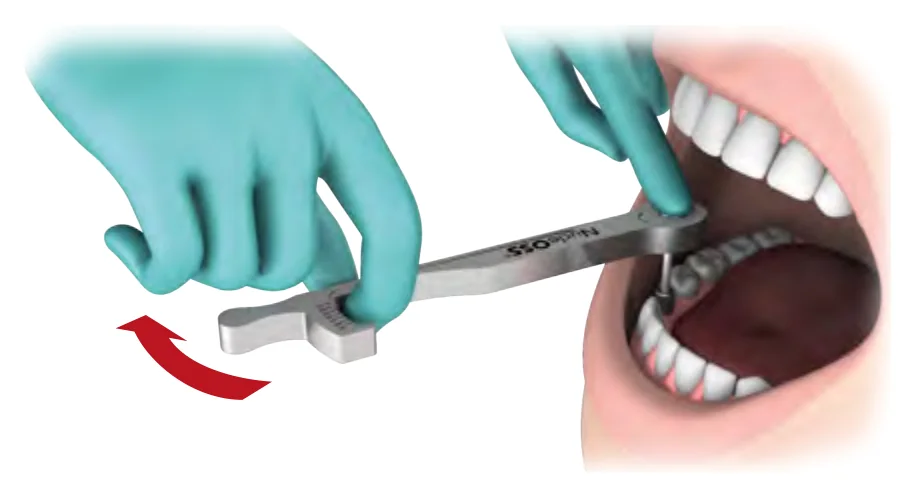 Using the ratchet as a torqueless ratchet, with the torque arm and needle held together