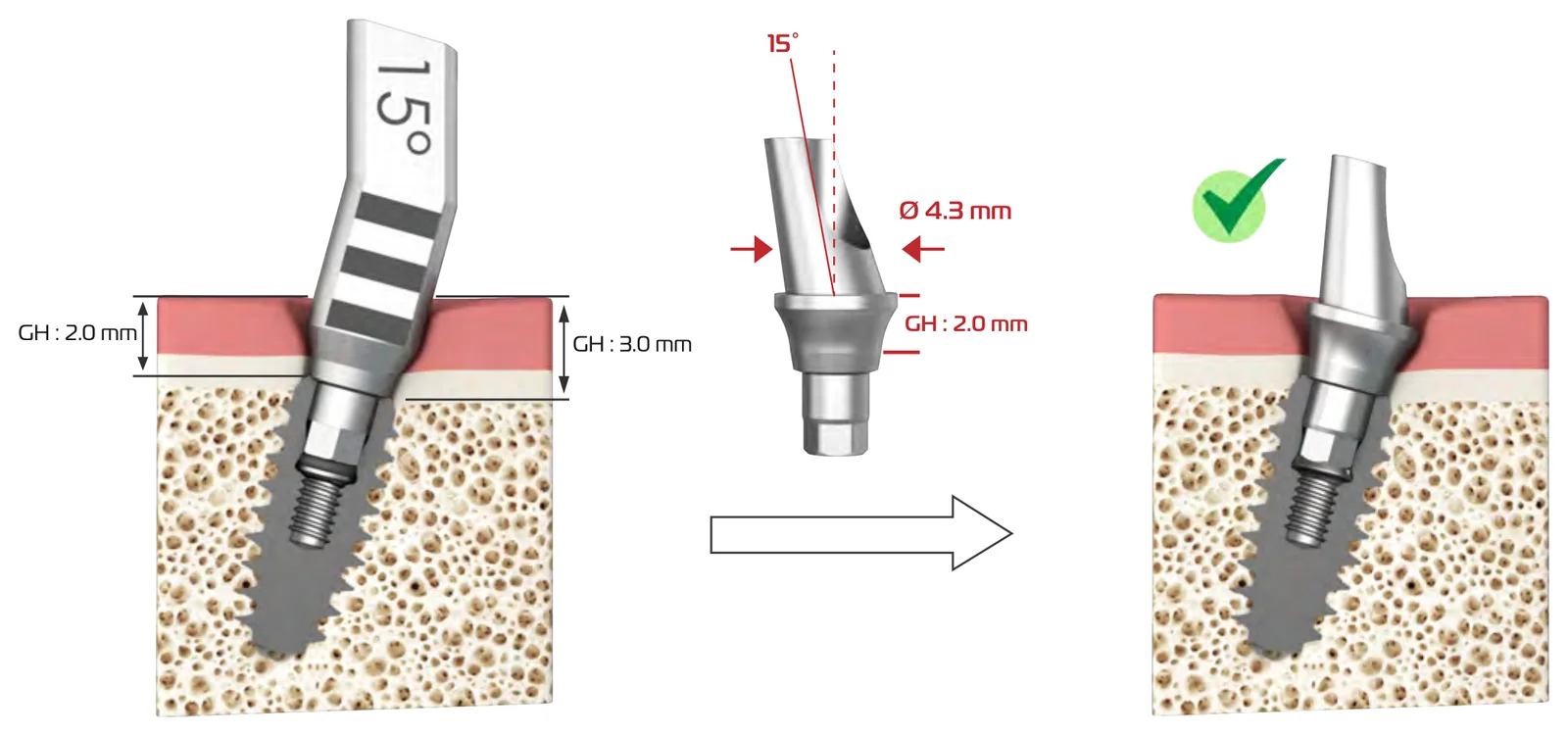 Worked example: a 15° planning part with GH 2.0 mm and GH 3.0 mm on opposite sides, and the matching 15° abutment, Ø 4.3 mm, GH 2.0 mm