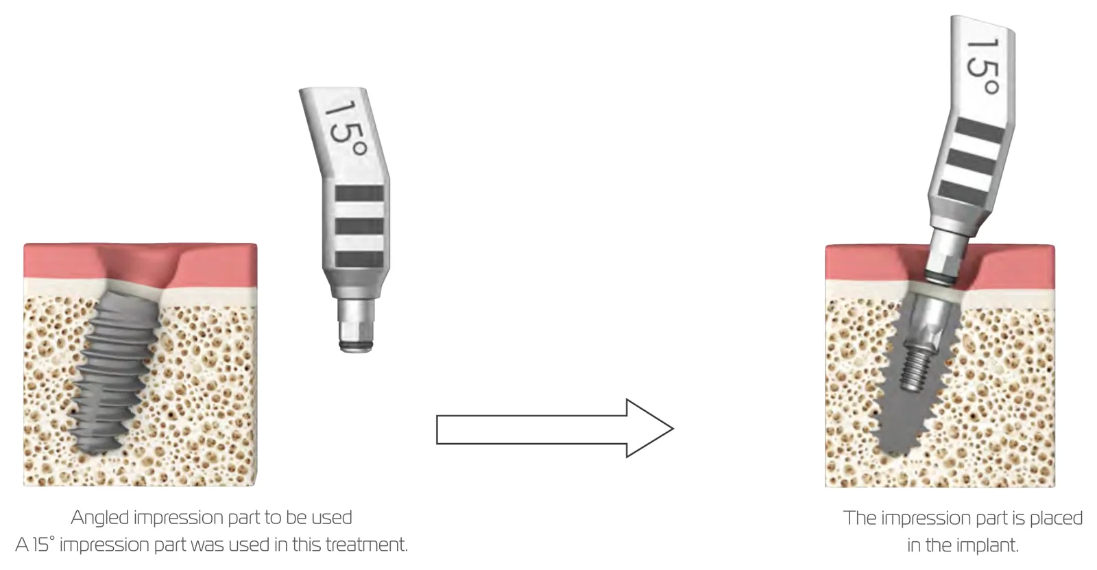 Using an angled planning part: select the 15° part and place it in the implant