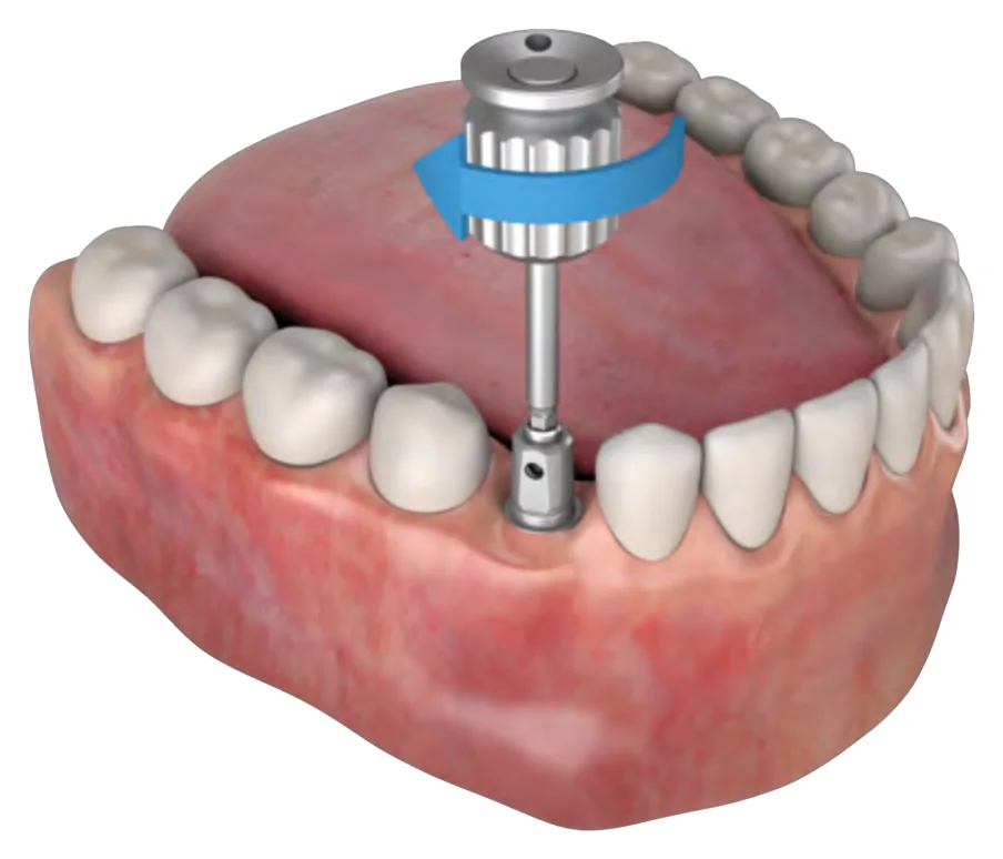 The manual hex driver turning a screw in a patient’s lower jaw