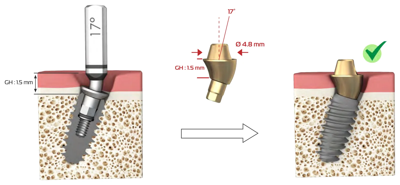 Worked example: a 17° planning part with GH 1.5 mm and the matching 17° multi-unit abutment, Ø 4.8 mm, GH 1.5 mm