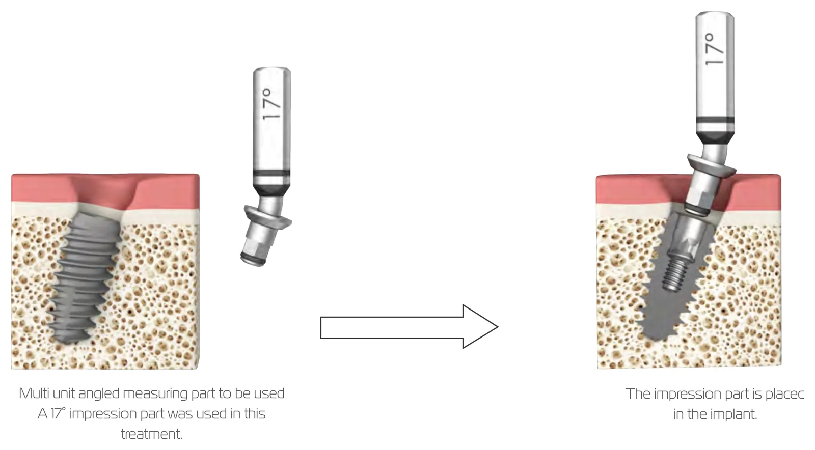 Using a multi-unit angled planning part: select the 17° part and place it in the implant