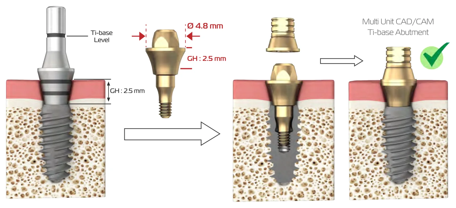 Worked example: Ti-base level, GH 2.5 mm, Ø 4.8 mm, and the multi-unit CAD/CAM Ti-base abutment placed on the implant