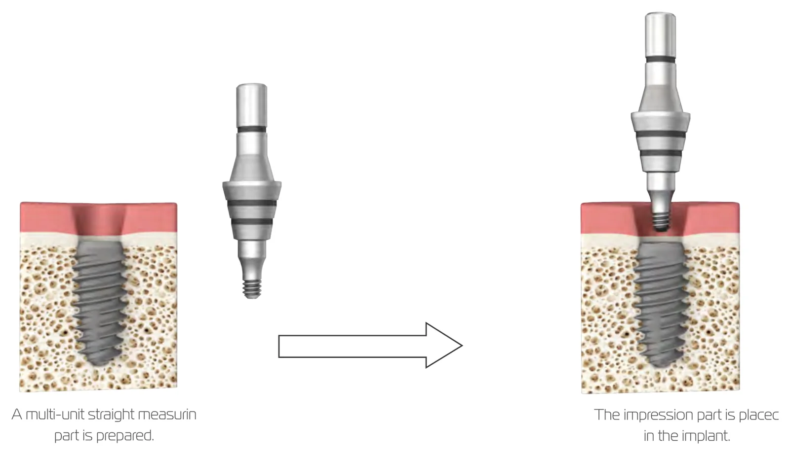 Using a multi-unit straight planning part: prepare the part and place it in the implant