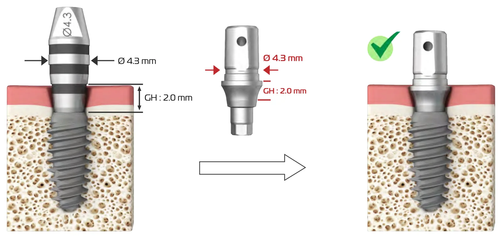 Worked example: a Ø 4.3 mm straight planning part with GH 2.0 mm, and the matching Ø 4.3 mm abutment