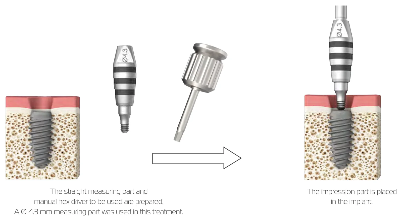 Using a straight planning part: prepare the part and the manual hex driver, then place the part in the implant