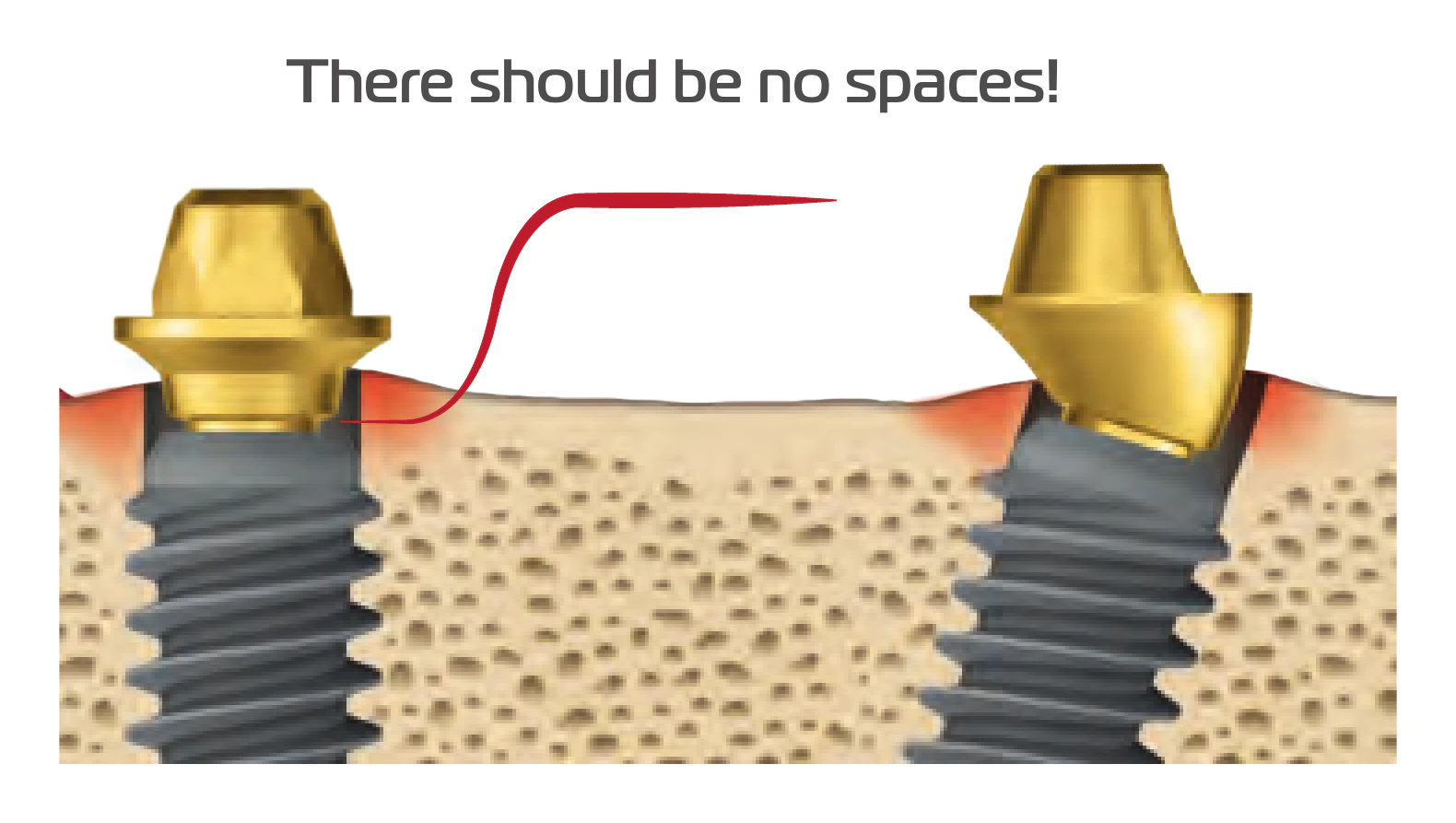 Two implants: abutment seated fully where the bone is level, and held off by uneven bone at the neck
