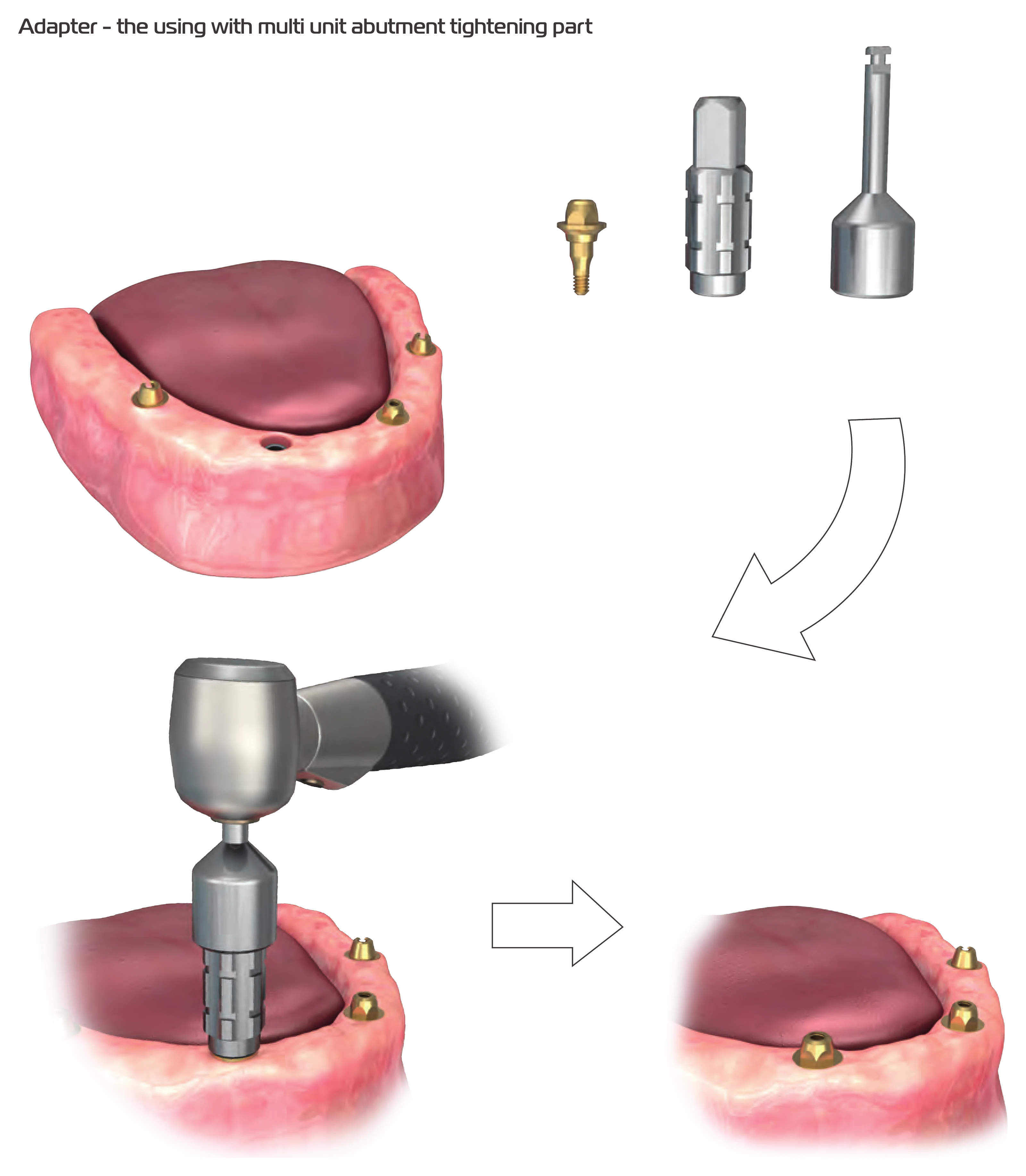 Multi-unit abutment, tightening part and adapter assembled on a micromotor to place the abutment