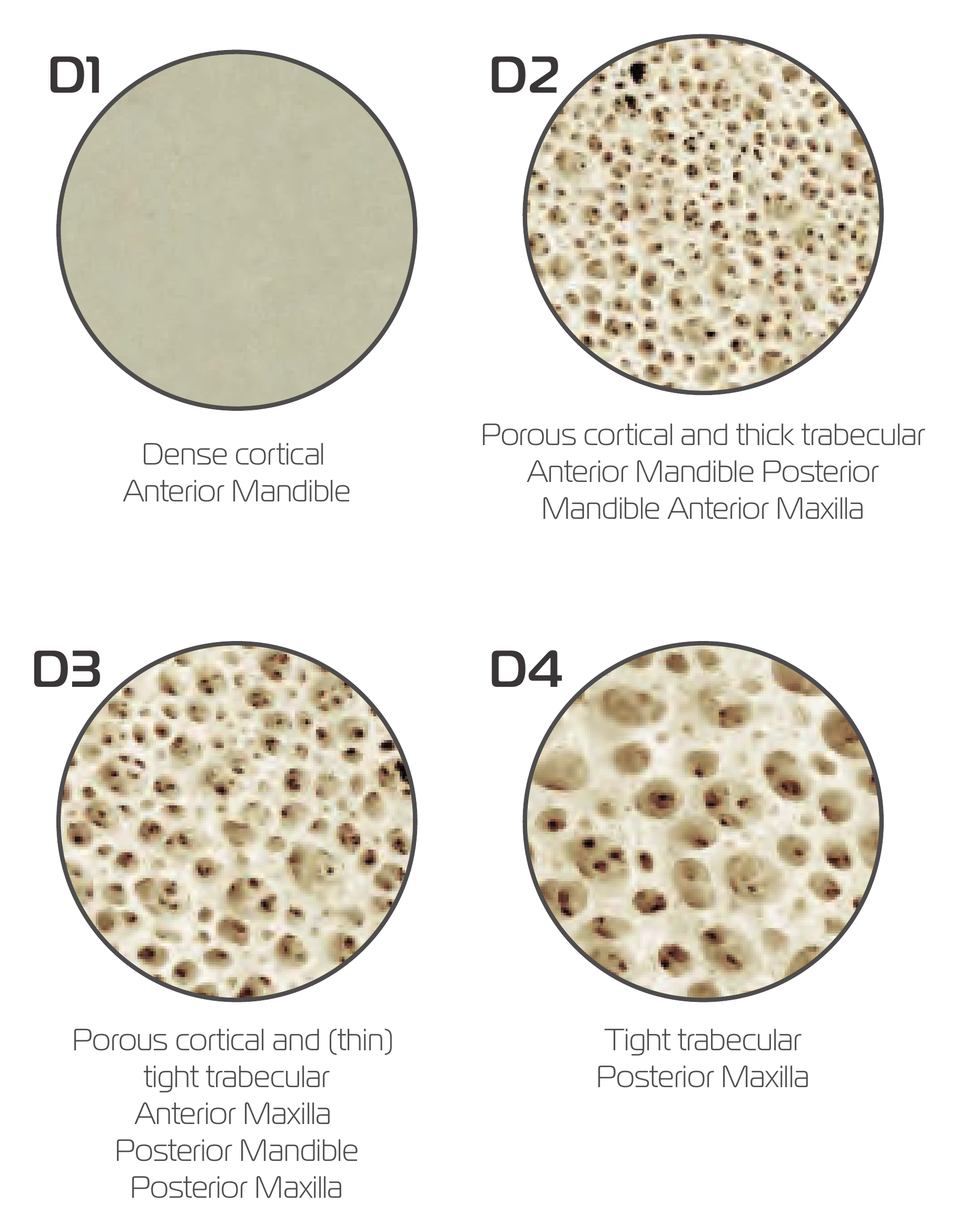 Bone samples for classes D1 (dense cortical), D2, D3 and D4 (tight trabecular) with their typical regions