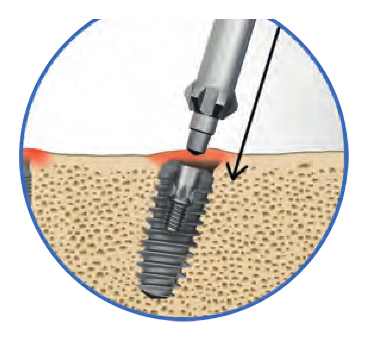 Bone profiler lowered over the guide pin in the implant