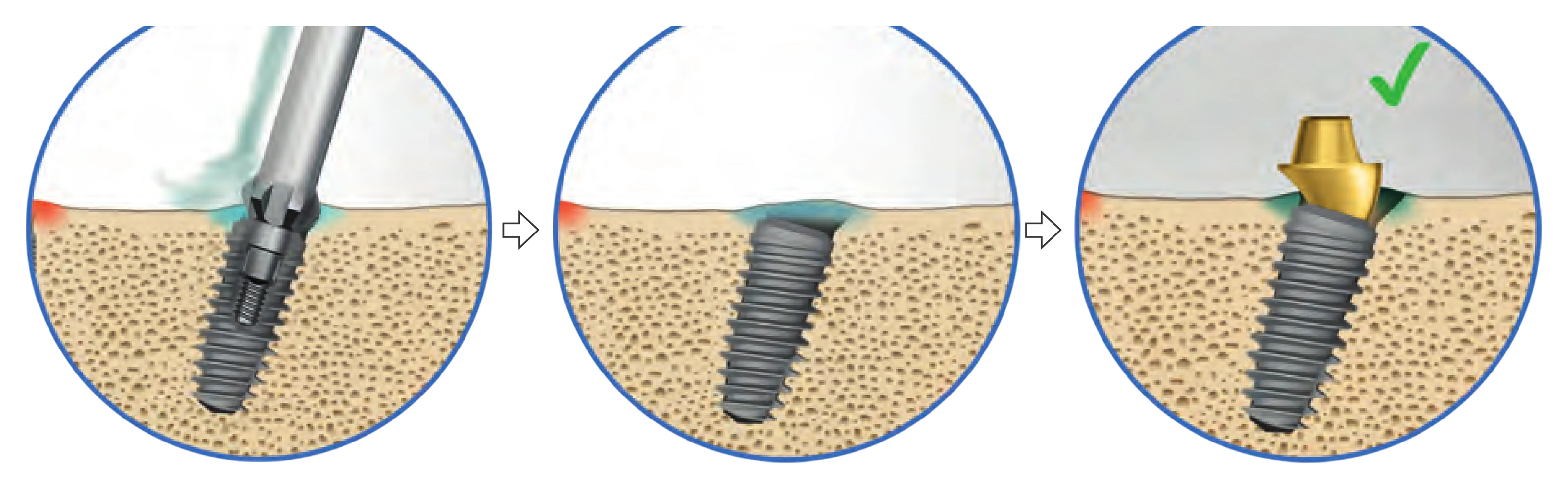 Three steps: profiling the neck with water cooling, level bone around the implant, abutment seated