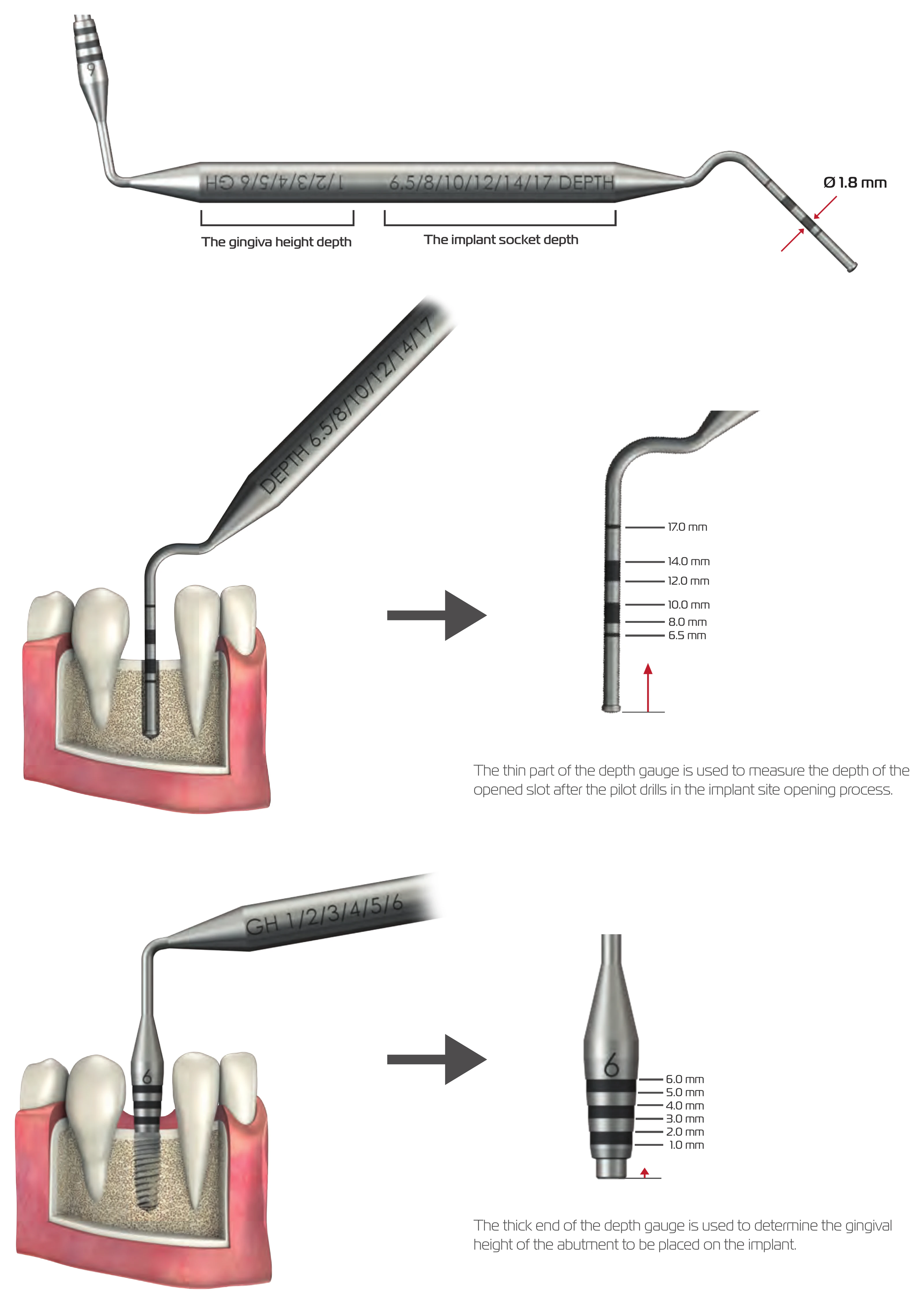 Depth gauge with socket depth marks 6.5 to 17.0 mm on the thin end and gingival height marks 1.0 to 6.0 mm on the thick end, shown in use