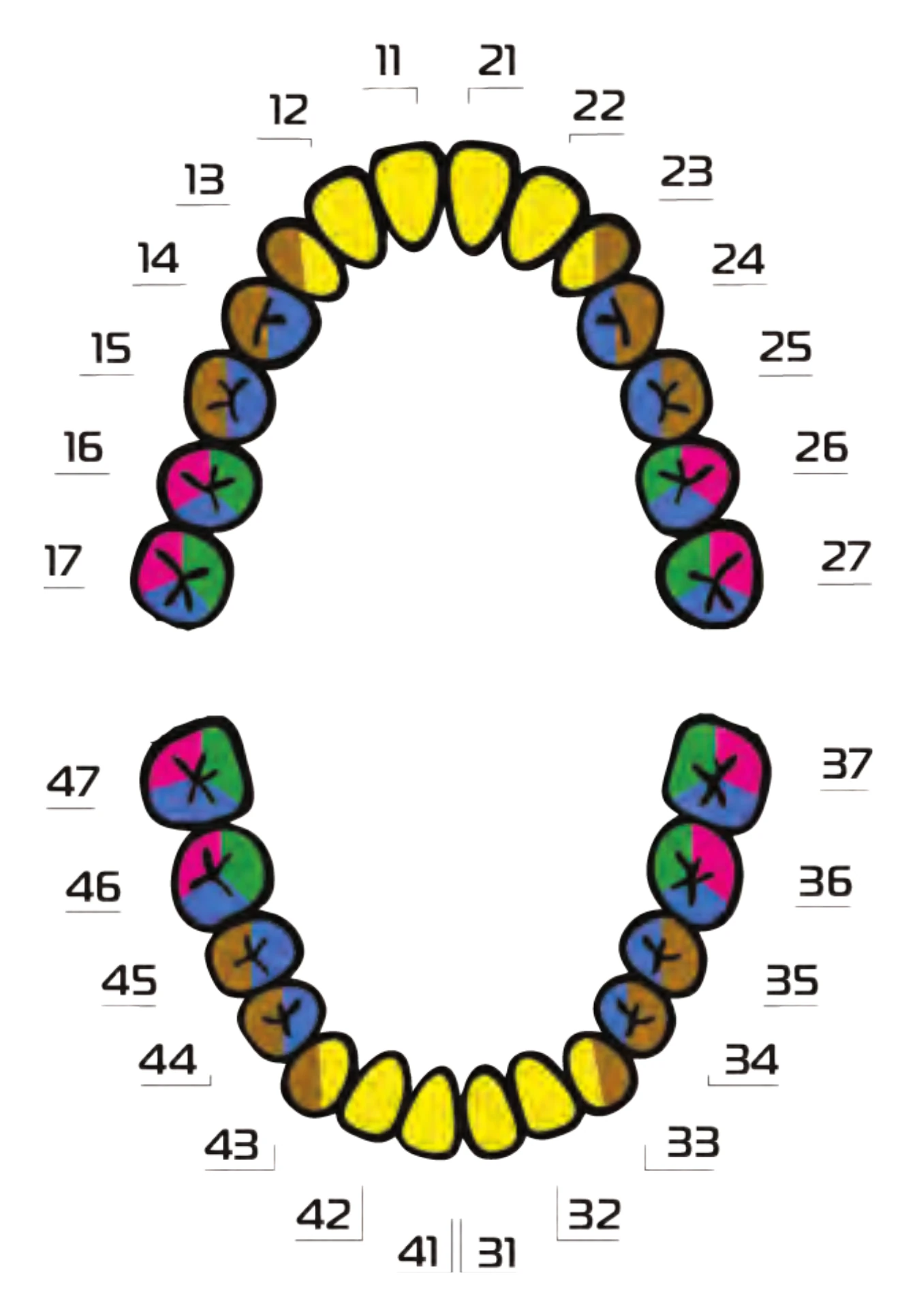 Dental chart of the upper and lower arches by tooth position, colour-coded with the implant diameter recommended for each position