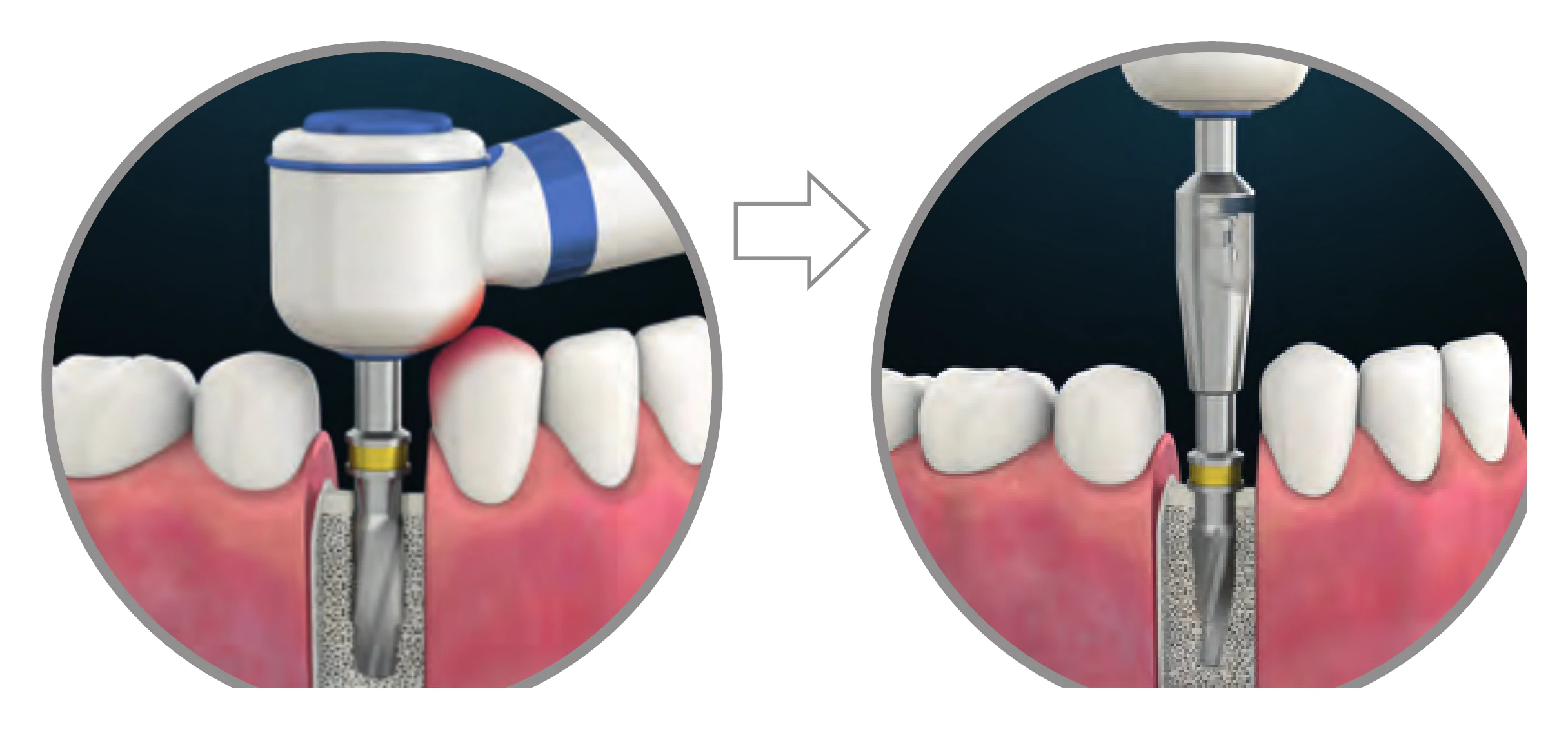 Drill extender lengthening a drill where the micromotor head cannot reach between adjacent teeth