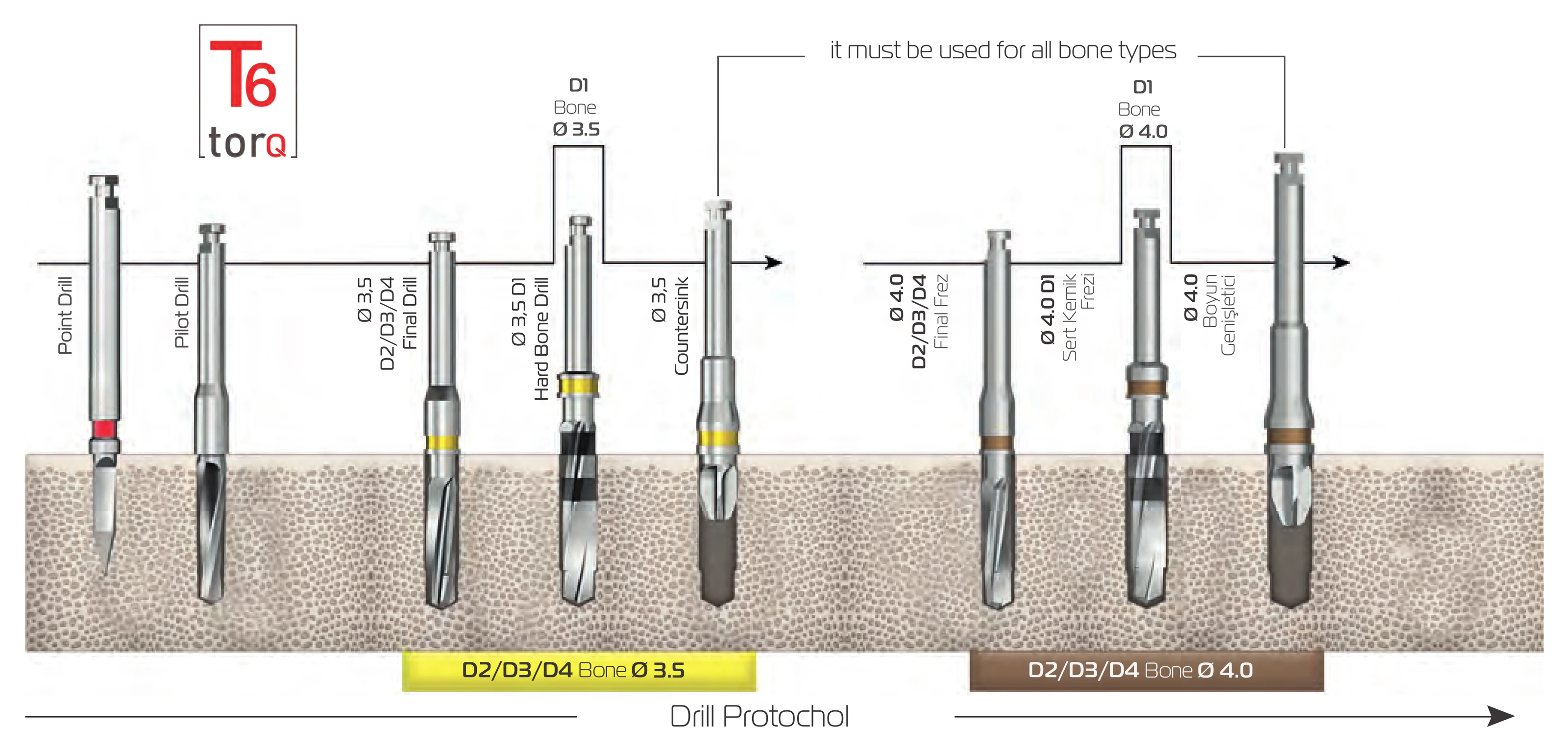 Drill protocol overview: point drill, pilot drill, then for Ø 3.5 and Ø 4.0 the final drill in D2/D3/D4 bone, the hard bone drill in D1 bone and the countersink for all bone types
