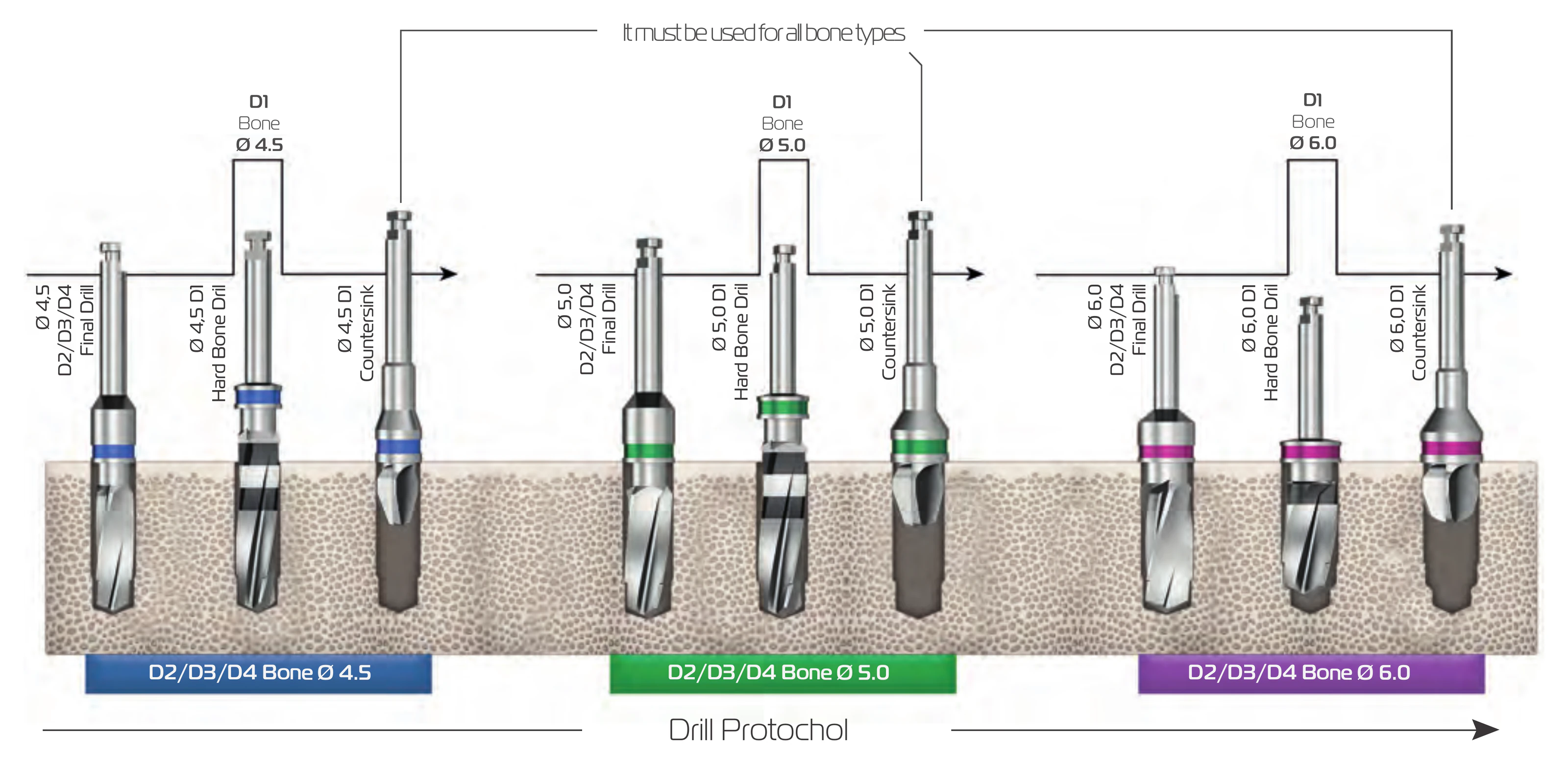 Drill protocol overview for Ø 4.5, Ø 5.0 and Ø 6.0: final drill in D2/D3/D4 bone, hard bone drill in D1 bone and countersink for all bone types