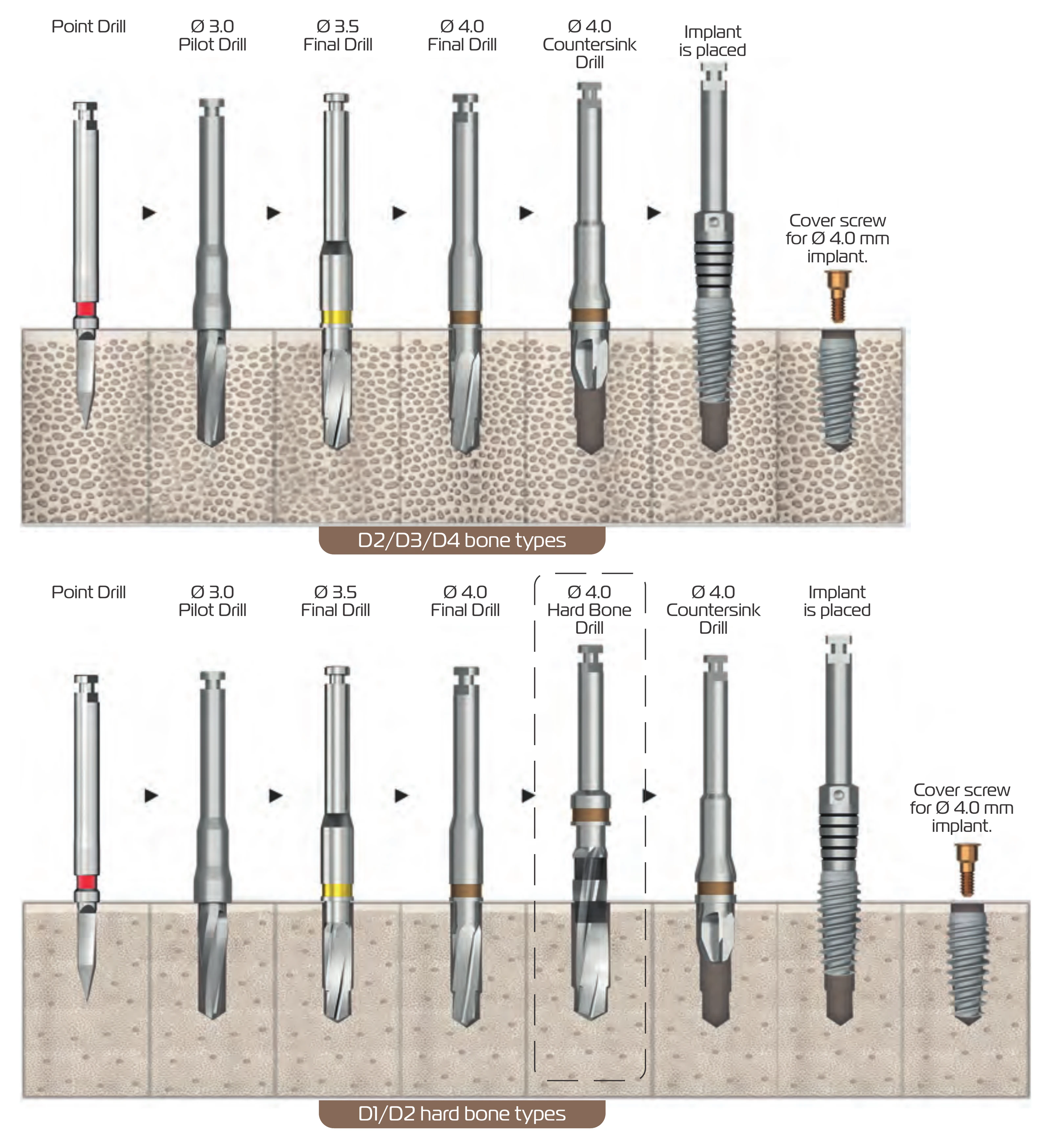 Manufacturer drill sequence figure for Ø 4.0 mm T6 Torq implants, D2 to D4 and D1/D2 bone