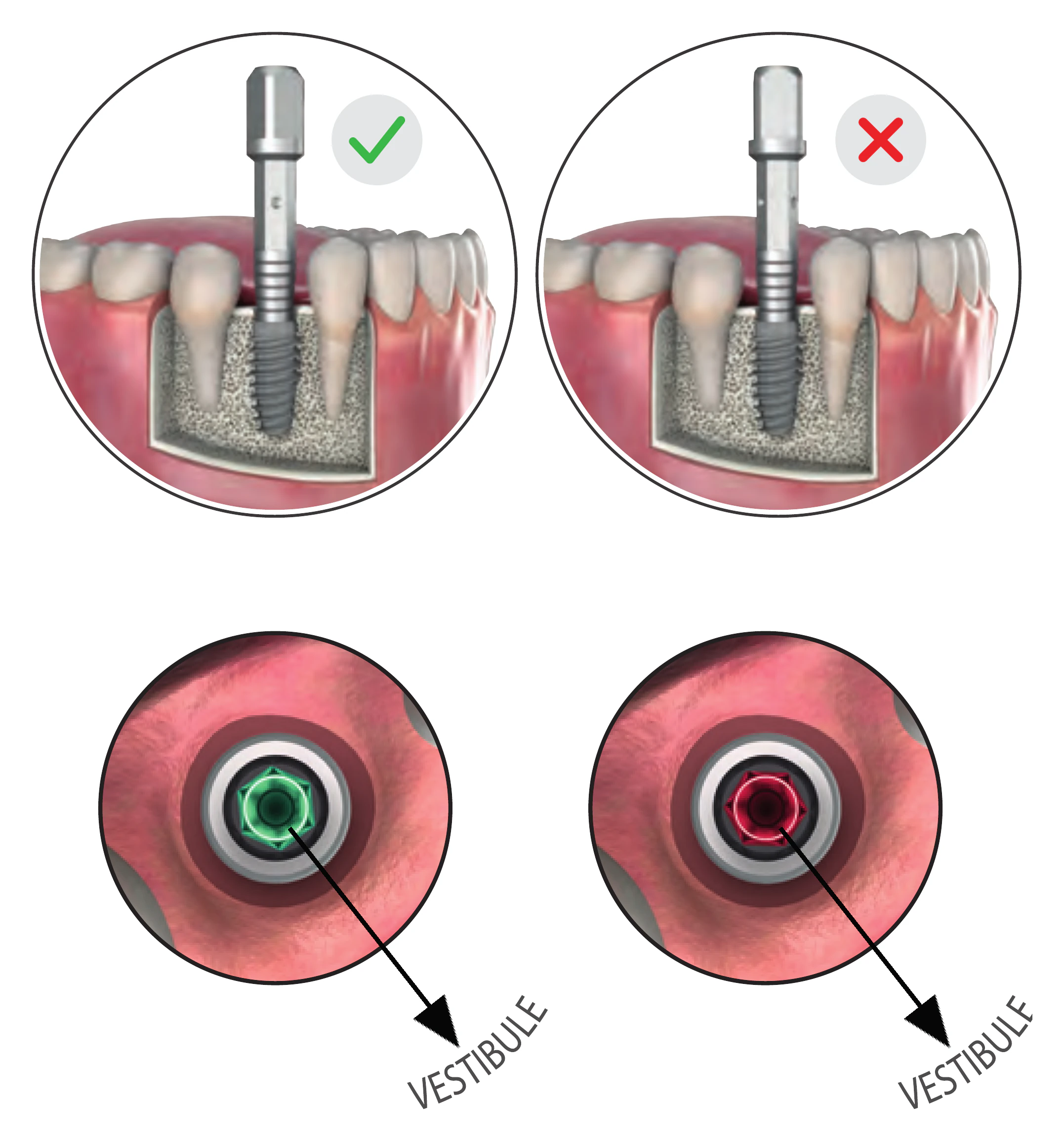 Correct and incorrect implant orientation: with the transfer part dots towards the vestibule the hex flat faces the vestibule