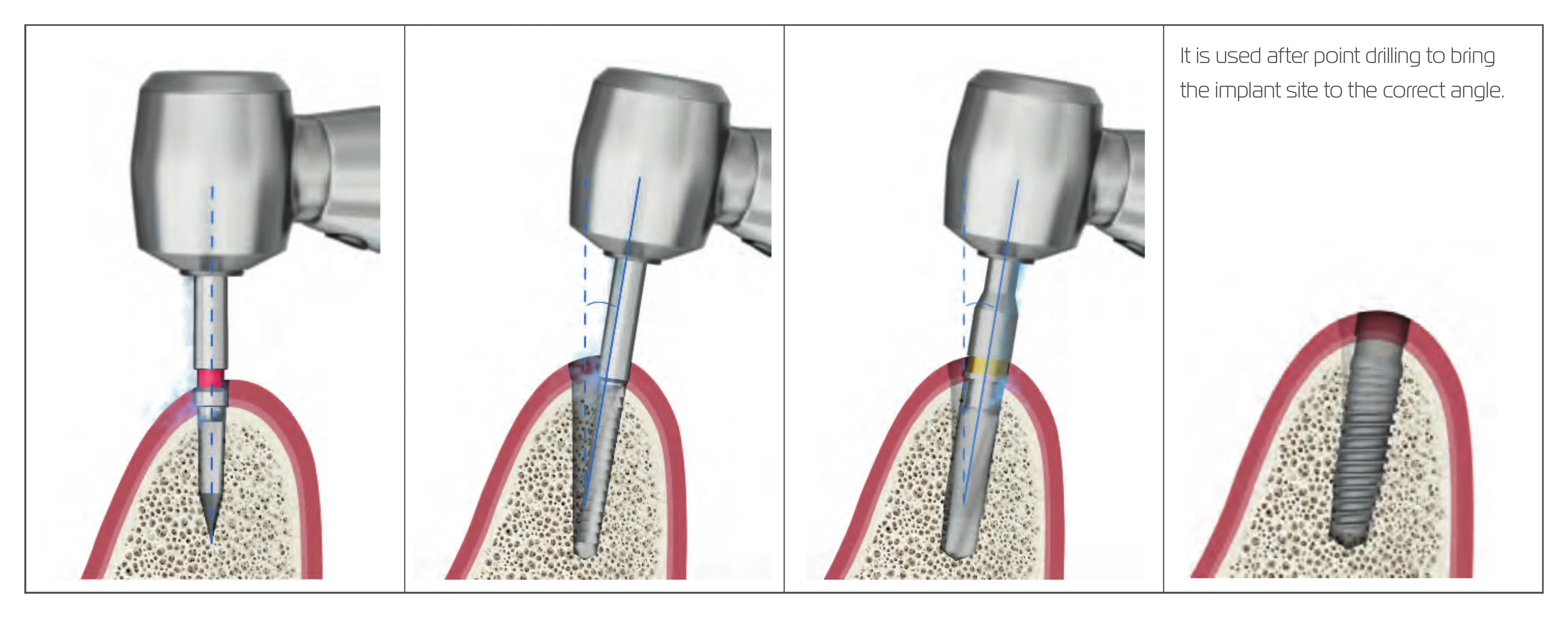 Four steps showing the Lindemann drill used after point drilling to bring the implant site to the correct angle