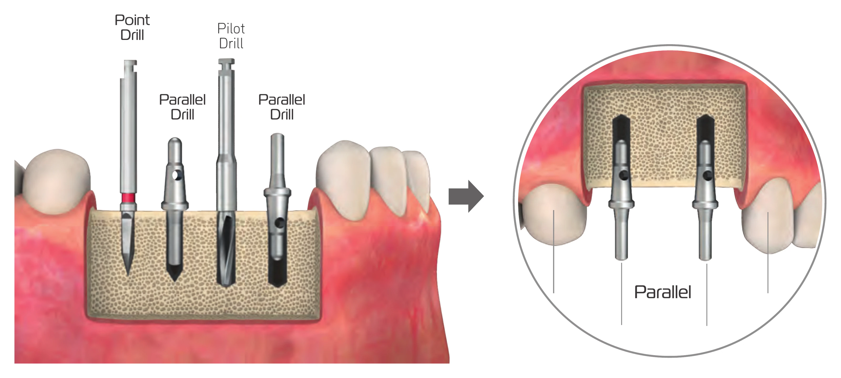Parallel pins placed after the point drill and the pilot drill to check parallelism between two implant cavities