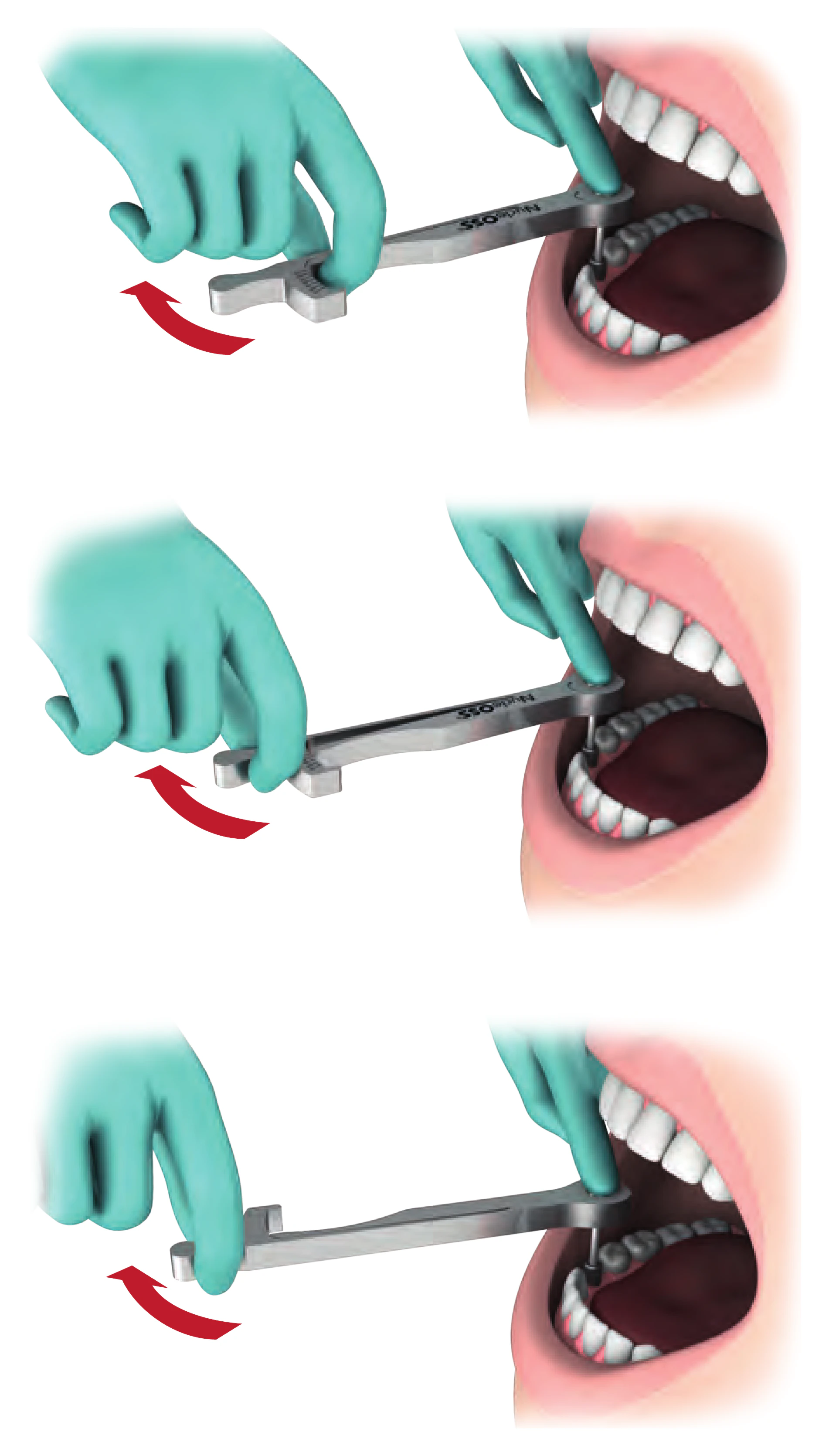 Three uses of the ratchet: torqueless with arm and needle held together, torque by pulling the arm, and removal with the arrow facing down