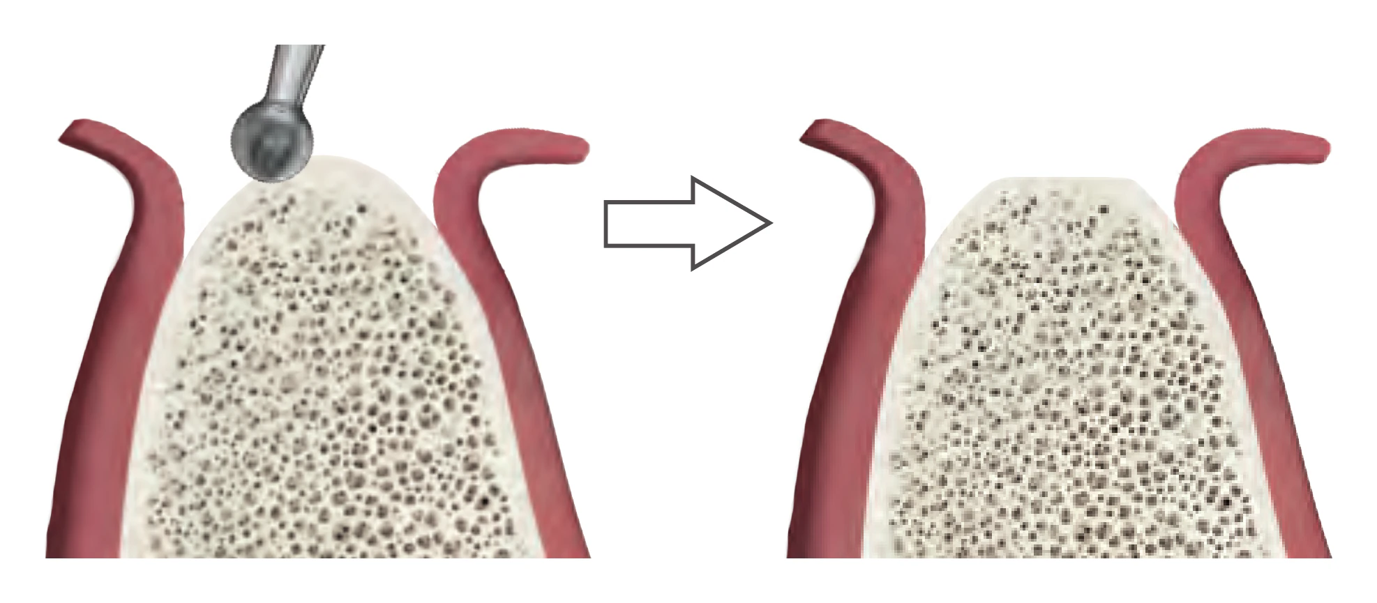 Round drill smoothing an irregular crest before osteotomy