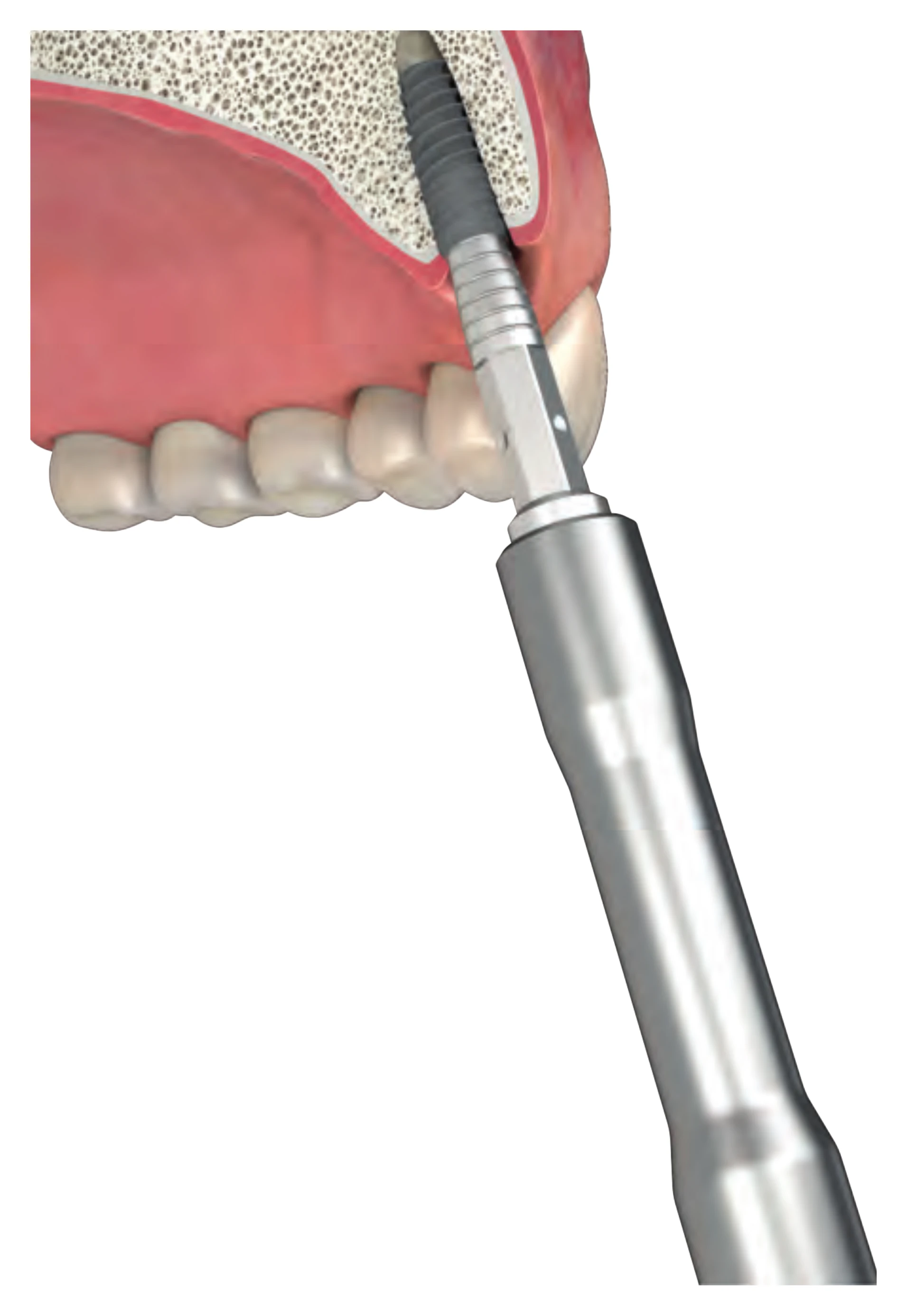Screwdriver placing an implant in the anterior maxilla