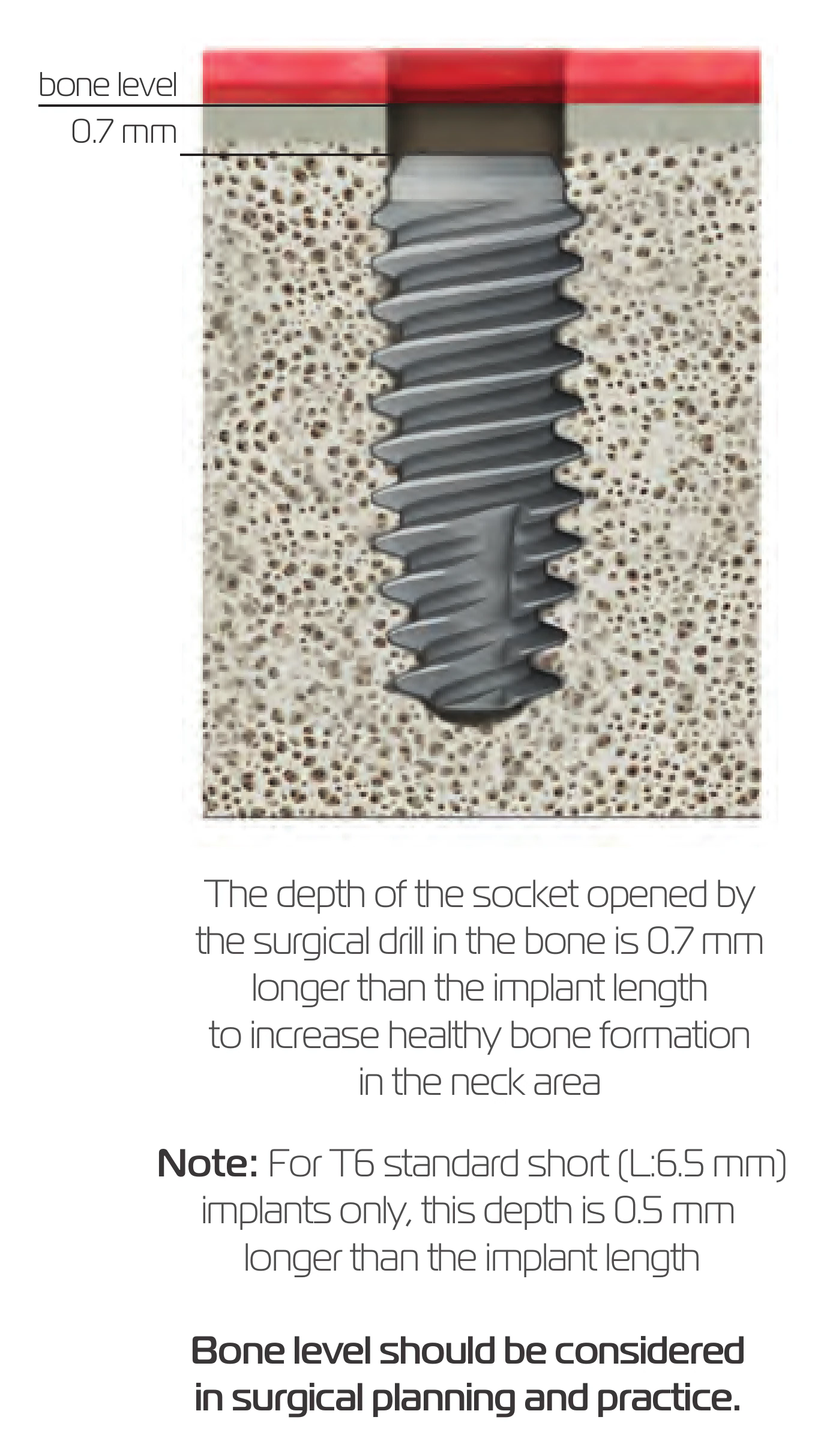 Implant seated 0.7 mm below bone level in its socket, with the note on socket depth for standard and 6.5 mm implants